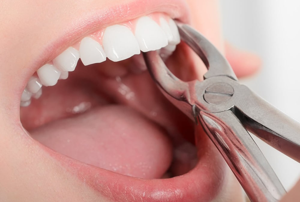 20'lik yaş diş çıkarma tedavisi